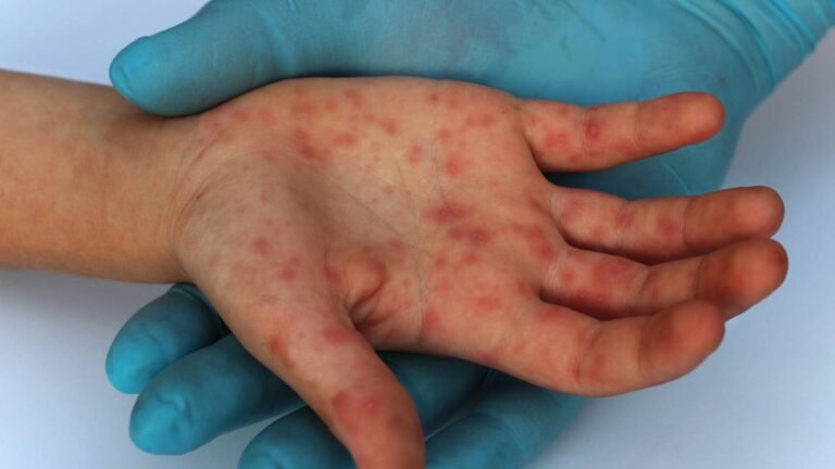Yucatán registra 34 casos de viruela símica